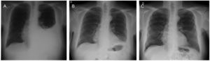 Controles radiológicos de un caso de nuestra experiencia previo al drenaje (A), tras toracocentesis izquierda (B) y una semana más tarde tras realizar regularmente ejercicios de fisioterapia respiratoria (C).