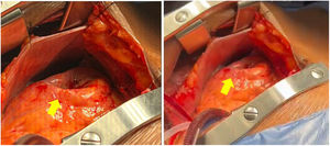 Presencia de dilatación aneurismática del ventrículo izquierdo (flecha amarilla).