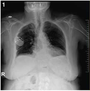 Izquierda) Rx de tórax: proyección posteroaterior. Presencia de electrodo monocameral endocavitario y generador de marcapasos.