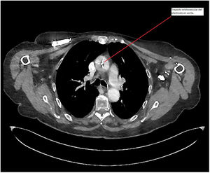 TC torácico que evidencia presencia de electrodo transaórtico. Línea roja señala electrodo en su trayecto por aorta ascendente. El color de la figura solo puede apreciarse en la versión electrónica.