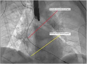 Ambos electrodos. Intraarterial (transaórtico), antiguo (línea roja), e intravenoso, nuevo (línea amarilla), previo a la retirada del electrodo intraarterial, por ser paciente dependiente de marcapasos. El color de la figura solo puede apreciarse en la versión electrónica.