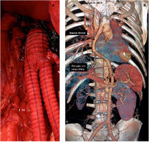 A) Injerto bifurcado aortobifemoral con anastomosis aórtica T-T y reimplante de arteria mesentérica inferior. B) Técnica de revascularización alternativa en un paciente con obstrucción aórtica yuxtarrenal, oclusión de arteria renal derecha y de los troncos digestivos. La aorta descendente era inadecuada como inflow (ectásica y con trombo). Se practicó bypass desde aorta ascendente, retrohepático, retropancreático a ambas arterias femorales comunes, con revascularización anterógrada del tronco celíaco y arteria mesentérica superior mediante pontajes con vena safena.