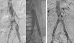 Kissing-stent con stents recubiertos. A) Arteriografia previa al tratamiento en la que se observa un coral reef en la aorta infrarrenal. B) Técnica kissing-stent (2 stents recubiertos balón-expandibles VBX® 11×79mm en bifurcación aórtica). C) Arteriografía de control final en la que se observa permeabilidad de ambos stents, además de la arteria mesentérica inferior y ambas arterias hipogástricas.