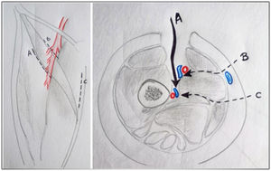 Abordajes anteriores de la arteria femoral profunda, lateral (A) o medial (B) a músculo sartorio. Abordaje posterior (C) de la arteria femoral profunda.