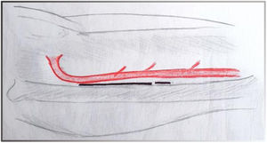 Abordaje lateral de la arteria tibial anterior. Incisión entre el músculo extensor largo de los dedos y el músculo tibial anterior mediante disección roma.