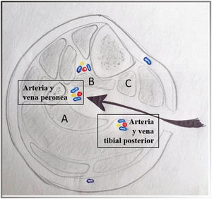 Abordaje medial de la arteria peronea y cómo quedan dispuestos los músculos y el paquete tibial posterior si fuera una exposición más caudal. A)Músculo flexor del primer dedo. B)Músculo tibial posterior. C)Músculo flexor largo de los dedos.