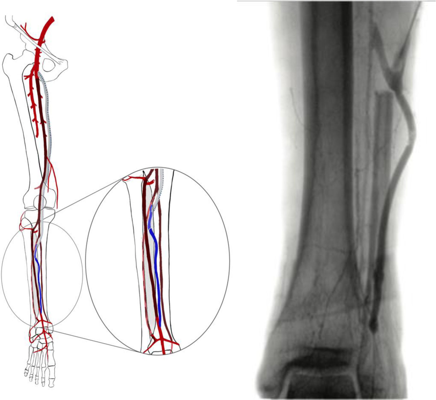 Revascularización de extremidades