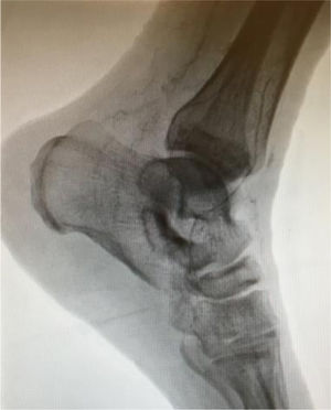 Detalle anatómico de la angiografía por punción femoral, con permeabilidad de un colateral lateral de la arteria peronea.