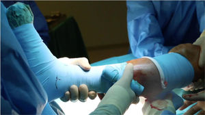 Detalle de la utilización de la venda de Esmarch.