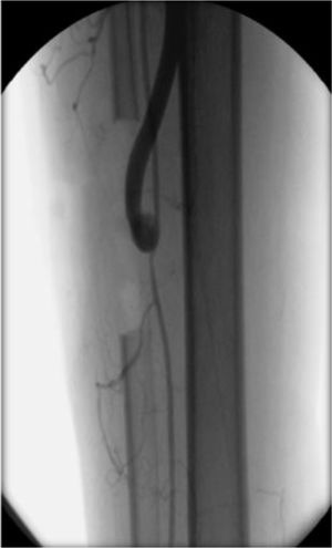 Control angiográfico de un bypass con PTFE y cuff de vena a la peronea, por abordaje lateral.