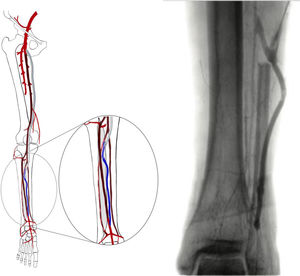 Bypass en T invertida.
