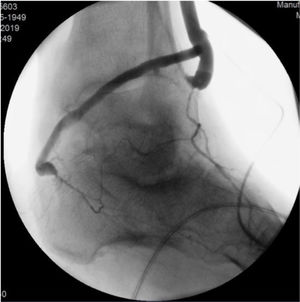 Bypass con doble salida a una plantar y a un colateral de la pedia.