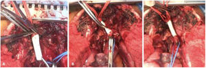 Surgical reconstruction of the brachiocephalic trunk. (A) Proximal anastomosis using lateral anchor technique with a PTFE synthetic graft. (B) Distal parachute anastomosis of the PTFE graft to the proximal part of the brachiocephalic trunk. (C) Final reconstruction.