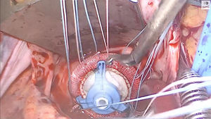 Prótesis tricúspide anudada con bajanudos.