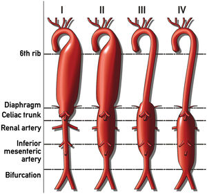 Esquema de clasificación por extensión de Crawford12 de los aneurismas de la aorta toracoabdominal. Modificado y con autorización de Cardiatis-Own work, CC BY-SA 4.0, https://en.wikipedia.org/wiki/File:D3ON0p6B.jpg.