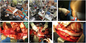 Estrategias intraoperatorias en cirugía abierta de los aneurismas de la aorta toracoabdominal. A) Abordaje toracoabdominal. B) Sistemas de alta capacidad de recuperación celular hemática y de perfusión de alto flujo. C) Drenaje de líquido cefalorraquídeo y monitorización de la presión intratecal. D) Clampaje aórtico secuencial. E) Perfusión selectiva renal y visceral durante la fase de isquemia. F) Vista del injerto tras la sustitución de la aorta toracoabdominal.