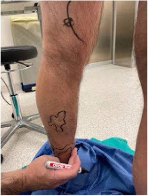 Marcaje preoperatorio de venas a extirpar.