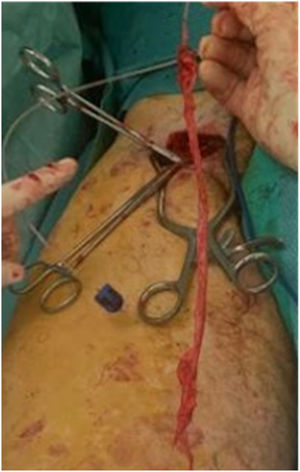 Vena safena mayor extirpada con fleboextractor.