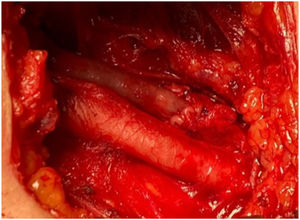 Bypass a vena femoral por lesión de la misma en la fleboextracción.
