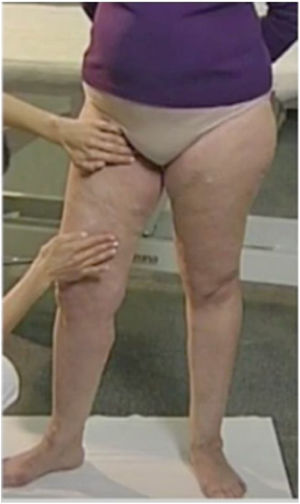 Prueba de Schwartz en paciente con reflujo venoso.