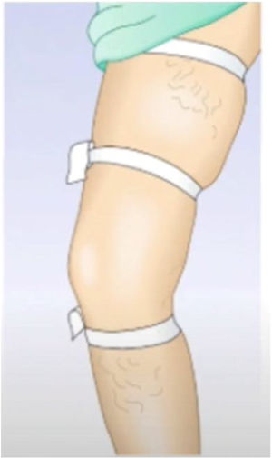 Disposición de las ligaduras en la prueba de Perthes.