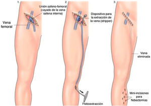 Esquema de abordaje de safenectomía mediante técnica abierta con incisión en herida inguinal para abordar el cayado de la vena safena interna y paso del fleboextractor.