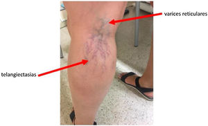 Varices reticulares y telangiectasias en paciente con insuficiencia venosa grado C1.