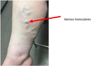Varices tronculares en paciente con insuficiencia venosa grado C2.