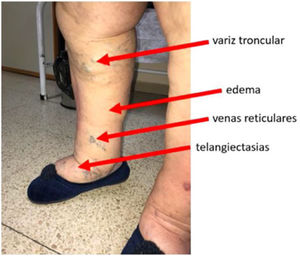 Varices tronculares, edema y telangiectasias en paciente con insuficiencia venosa grado C3.