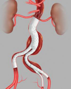 Endoprótesis Zenith Alpha® (Cook).