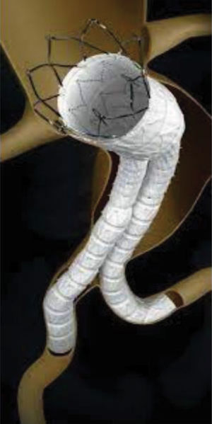 Endoprótesis Incraft® (Cordis).