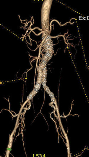 Endoprótesis Aorfix® (Lombard).