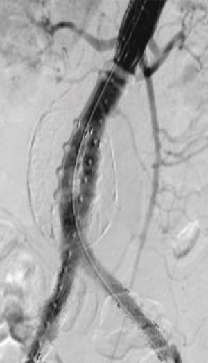 Endoprótesis ALTO® (Endologix).