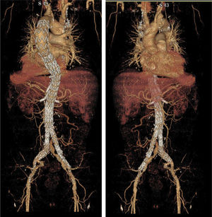 Endoprótesis con ramas y fenestraciones. Se puede apreciar que presenta 4 ramas para ambas renales, tronco celíaco y mesentérica superior y una fenestración para una arteria intercostal de gran diámetro (4mm), en la que se aplicó un stent para minimizar riesgos de isquemia medular.