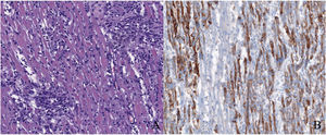 La Figura 2A muestra un infiltrado linfocitario difuso con linfocitos CD3+. La tinción inmunohistoquímica para CD9 (2B) muestra una extensa necrosis de las fibras miocárdicas.