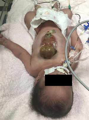 Recién nacido con ectopia cordis y defecto de pared abdominal.