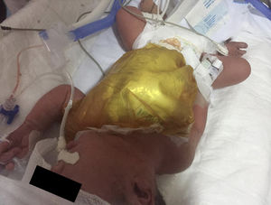Colocación de parche prequirúrgico para cubrir el defecto y evitar lesiones cardiacas.