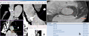 a) Medidas del anillo aórtico realizadas en el programa OsiriX®; b) Medidas del anillo aórtico realizadas en el programa 3mensio®.