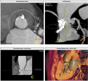 a) Muestra la calcificación del anillo aórtico, a nivel de velo derecho; b y c) Se observa la intensa calcificación a nivel de dicho velo, así como en el tracto de salida del ventrículo izquierdo; d) Imagen de reconstrucción en modo VR, que muestra anatómicamente dicha calcificación, algo que nos puede dar idea del riesgo del implante en este caso.