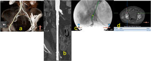 a) Imagen de reconstrucción en modo VR, del sitio de punción y las medidas de la arteria femoral a dicho nivel; b) Muestra la arteria diana desde la bifurcación femoral a la aorta abdominal, donde podemos evaluar los diámetros, las calcificaciones y los tombos; c) Muestra arteriografía del sitio de punción, sus relaciones con las estructuras vecinas, algo que facilita la punción en el sitio indicado; d) Imagen de corte axial a nivel del sitio de punción que nos muestra la profundidad de la arteria, dato importante en el caso del empleo del sistema de cierre percutáneo Manta.