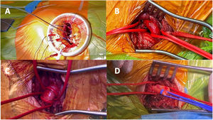 A) Acceso transapical para TAVI. B) Acceso transaxilar izquierdo para TAVI. C) Acceso transcarotídeo izquierdo para TAVI. D) Acceso para TAVI a través del tronco braquiocefálico.