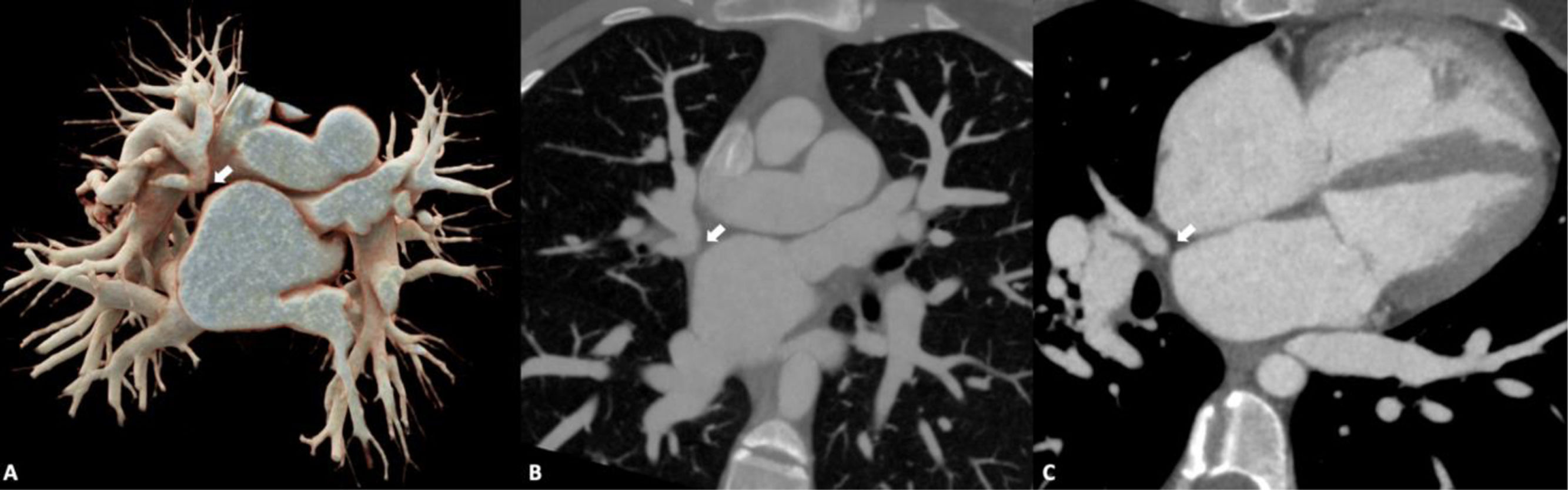 Multiplanar Volume Rendering Asociación entre conexión anómala parcial de venas pulmonares y atresia ...