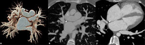 A) MDTC en formato volume-render mostrando atresia del ostium de la vena superior derecha (flecha blanca). B) Multiplanar en MDTC demostrando atresia del ostium con el resto de las venas pulmonares drenando normalmente hacia la aurícula izquierda. C) Vista MPR de cuatro cámaras que muestra la atresia del ostium y la ampliación de las cavidades del lado derecho.