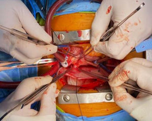 Foto intraoperatoria que muestra la llegada de la vena pulmonar superior derecha a la aurícula izquierda hasta un saco ciego.