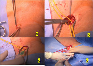 a)Incisión de 3-4cm anterior al esternocleidomastoideo izquierdo. b)Disección de la arteria carótida izquierda común y aplicación de la bolsa de tabaco con Prolene 5/0. c)Colocación del introductor 6F dentro de dicha bolsa de tabaco. d)Colocación del introductor 16F para la valvuloplastia previa al implante de prótesis autoexpandible.