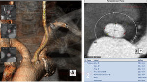 A) Reconstrucción de arteria carótida izquierda y B)medida estandarizada de anillo aórtico. Ambas realizadas a través del software 3mensio™. Fuente: elaboración propia.