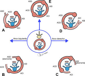 Ilustración de la evolución normal y patológica del arco aórtico clásico de Edwards (imagen dentro del círculo azul). A) Arco aórtico izquierdo normal, no forma anillo vascular. B) Arco aórtico izquierdo con ARSA retroesofágica. Se trata de un anillo vascular incompleto. Anillo laxo. C) Arco aórtico derecho con ALSA. El ligamento ductal cierra el anillo. Se trata de un anillo completo. D) Arco aórtico derecho en imagen en espejo con ductus posterior e izquierdo. Se trata de un anillo completo. E) Doble arco aórtico. Se trata de un anillo completo. Anillo tenso. AA: aorta ascendente; ACD: arteria carótida derecha; ACI: arteria carótida izquierda; AD: aorta descendente; ASD: arteria subclavia derecha; ASI: arteria subclavia izquierda; TP: tronco pulmonar. Ilustraciones cedidas por el Dr. García Torres.