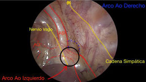 Imagen toracoscópica de doble arco aórtico. Arco aórtico (Ao) derecho, punteado azul. Arco aórtico (Ao) izquierdo hipoplásico, punteado rojo dentro de círculo negro. Aorta descendente, línea roja continua inferior. Nervio vago y cadena simpática, líneas amarillas correspondientes. ACI: arteria carótida izquierda; ASI: arteria subclavia izquierda; Ao: aórtico. Imagen cedida por el Dr. García Torres.