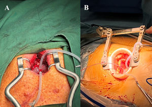 (A) Subxyphoid approach. Pig model. (B) Small left thoracotomy. Clinical case. Transapical guidewire.