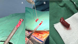 (A) Resected muscle within the sleeve tube of the resection device. (B) Resected muscle removed from the sleeve tube. (C) Surgical specimen.